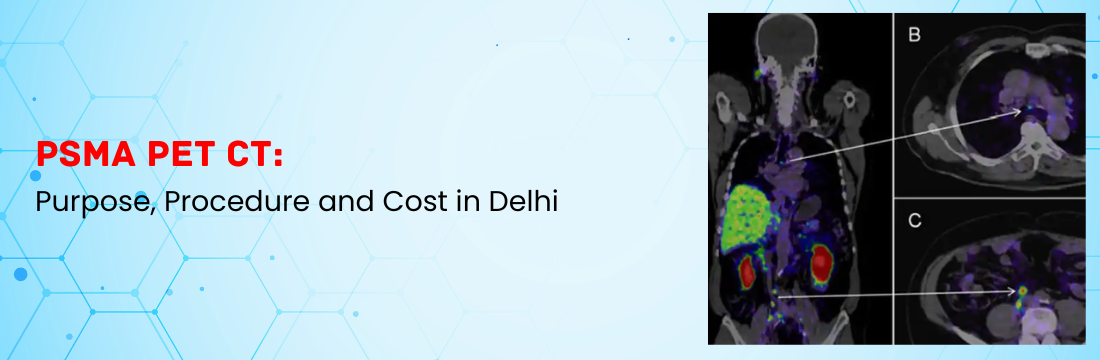 PSMA PET CT: Purpose, Procedure and Cost in Delhi